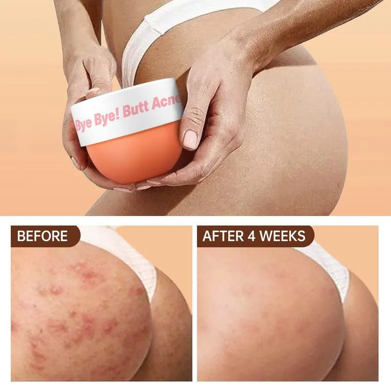 Butt Acne Clearing Cream, Butt Thigh Skin Care Clears Buttocks Zits, Pimples and Dark Spots, Moisturize Cream with Salicylic Acid & Tea Tree, Skin Delicate and Smooth Body Care 5.46 oz